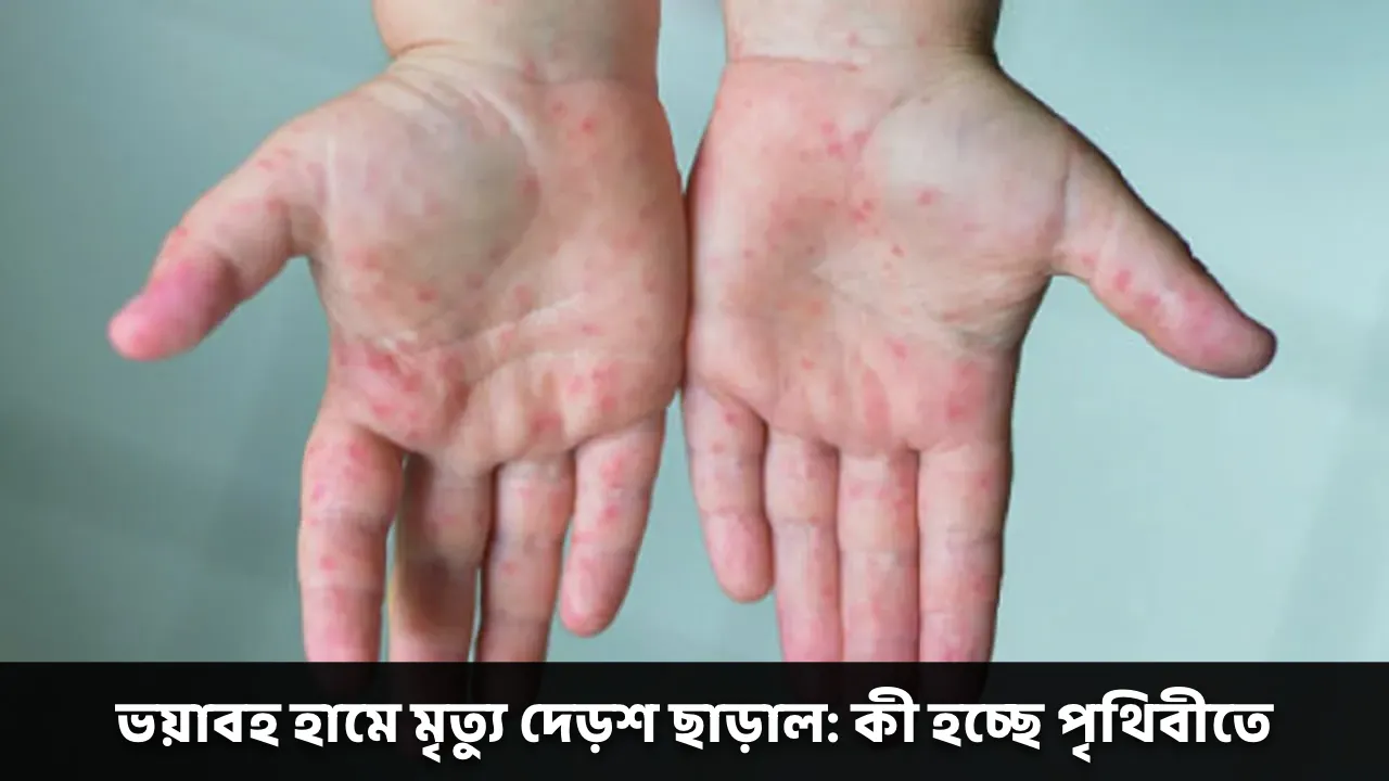 ভয়াবহ হামে মৃত্যু দেড়শ ছাড়াল: কী হচ্ছে পৃথিবীতে