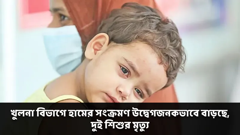 খুলনা বিভাগে হামের সংক্রমণ উদ্বেগজনকভাবে বাড়ছে, দুই শিশুর মৃত্যু